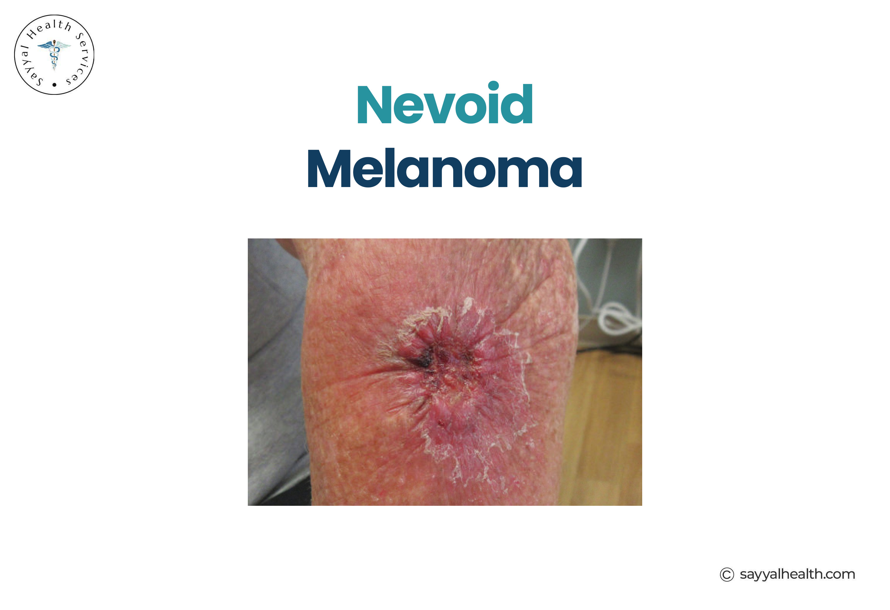 Nevoid Melanoma